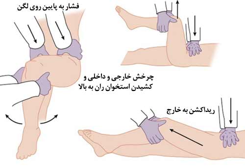 درمان دررفتگی مفصل لگن